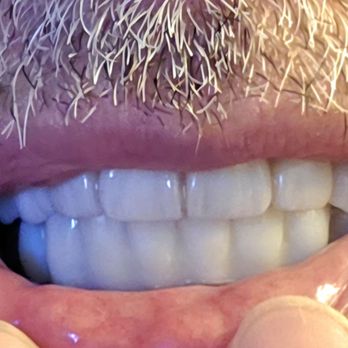 Implants Pro Center - Mohamed Ali, DDS - Tops are done the bottoms are the temporary teeth - Cosmetic Dentists Near Me - San Francisco, California Implants Pro Center - Mohamed Ali, DDS - Tops are done the bottoms are the temporary teeth - Cosmetic Dentists Near Me - San Francisco, California