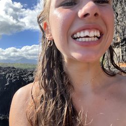 Princeville Dental - Tooth chipped after getting knocked off her feet at Kalihiwai Bay rocks. :/