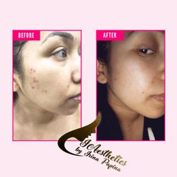 iAesthetics - After 1 treatment acne