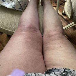 Leg on the left has the clot. If PA had bothered to do her job it could have been treated sooner. Leg on the left has the clot. If PA had bothered to do her job it could have been treated sooner.