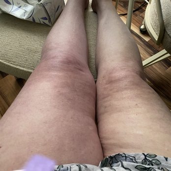 Banner Urgent Care - Leg on the left has the clot. If PA had bothered to do her job it could have been treated sooner. - Urgent Care Near Me - Mesa, Arizona Banner Urgent Care - Leg on the left has the clot. If PA had bothered to do her job it could have been treated sooner. - Urgent Care Near Me - Mesa, Arizona
