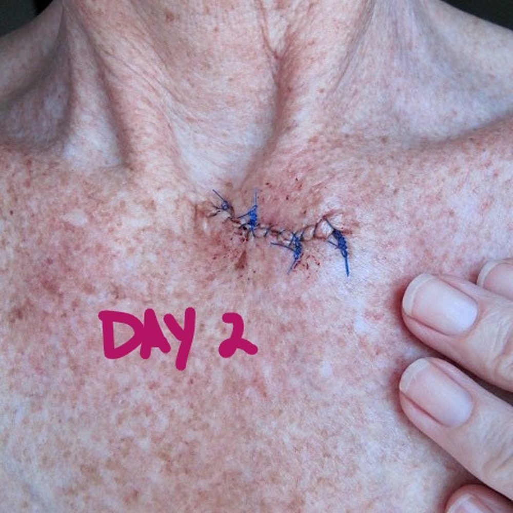 Elisabeth K Shim, MD - Dr. Shim: MOHS for basal cell carcinoma removal - Dermatologists Near Me - Santa Monica, California Elisabeth K Shim, MD - Dr. Shim: MOHS for basal cell carcinoma removal - Dermatologists Near Me - Santa Monica, California