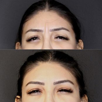 Brea Wellness Center - She received 20 units of Botox, look at the difference! - Laser Hair Removal Near Me - Fullerton, California Brea Wellness Center - She received 20 units of Botox, look at the difference! - Laser Hair Removal Near Me - Fullerton, California