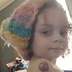 Joseph Schwartz, MD - Her birthmark today. Getting smaller and softer. We are hopeful it will be totally shrunk by the age of 5