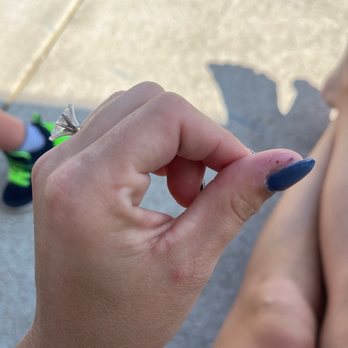 Florida Nail Spa - Blisters from excess filing - Nail Salons Near Me - Lynn Haven, Florida Florida Nail Spa - Blisters from excess filing - Nail Salons Near Me - Lynn Haven, Florida