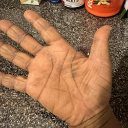 Sweet Nails - Palm of hand with rash on right hand.