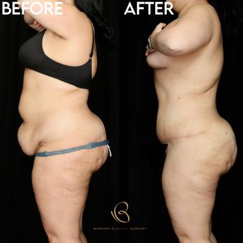 Burbank Plastic Surgery - Tummy Tuck - Cosmetic Surgeons Near Me - Burbank, California Burbank Plastic Surgery - Tummy Tuck - Cosmetic Surgeons Near Me - Burbank, California
