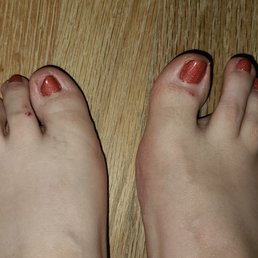 Broke the nail on my big toe. All the scraped spots on my feet are from the pedicure.