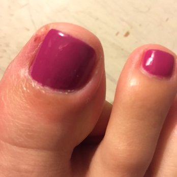La Vie Nails - Swollen and painful. This photo was taken about 48 hours after getting my nails done. - Nail Salons Near Me - Alameda, California La Vie Nails - Swollen and painful. This photo was taken about 48 hours after getting my nails done. - Nail Salons Near Me - Alameda, California