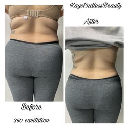 KaysEndlessBeauty - Cavitation