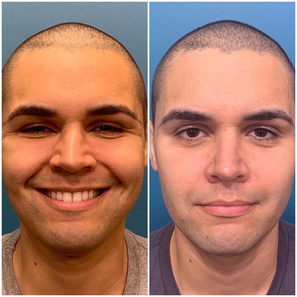 Before and After Before and After