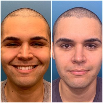 Vantis Institute - Before and After - Hair Loss Centers Near Me - Newport Beach, California Vantis Institute - Before and After - Hair Loss Centers Near Me - Newport Beach, California