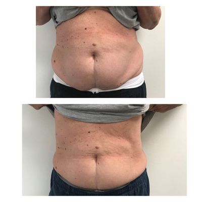 Results - Real Clients - Some before and after photos of actual CryoSculpt client results. Our treatments are designed for individuals seeking a non-invasive method to target localized fat and contour their bodies, this non-invasive is perfect for those aiming lose unwanted body fat.