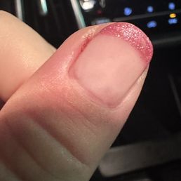 Infected thumb.