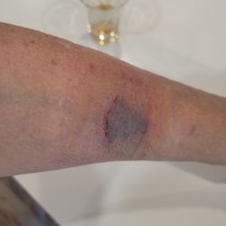 Harris Teeter - Injury to arm.
