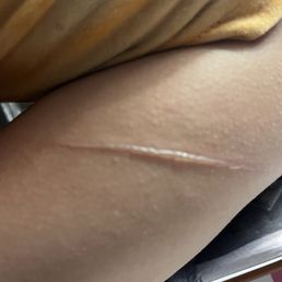Arm burn