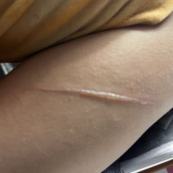 Saute Academy - Arm burn - Team Building Activities Near Me - Monrovia, California
