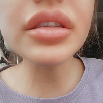 Beauty By Nayera - Immediately after lip filler - Medical Spas Near Me - Glendale, California Beauty By Nayera - Immediately after lip filler - Medical Spas Near Me - Glendale, California