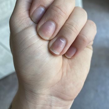 Collegeville Nails - Overfiled nails and nail trauma. Nails lifting off nail bed from being too filed down - Nail Salons Near Me - Collegeville, Pennsylvania Collegeville Nails - Overfiled nails and nail trauma. Nails lifting off nail bed from being too filed down - Nail Salons Near Me - Collegeville, Pennsylvania