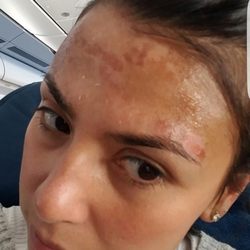 Bianka Skin Care - BEFORE TREATMENT: While in Oahu, I experienced an awful sunburn.