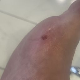 How lady created a sore on my foot, time to see a doctor.
