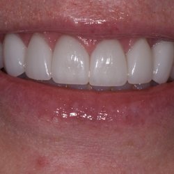 Mark Arooni, DDS - Lakeview Dental - A revision case. Replaced 10 old crowns to create, more natural, broader smile.