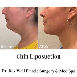 Dev Wali, MD Plastic Surgery-Medspa - Chin Liposuction by Dr. Wali