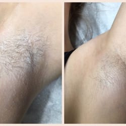 Simply Smooth - My clients results five weeks after her FIRST sugaring!