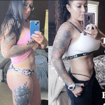 James D. Goggin, MD - The "before" pictures of loose skin. I naturally lost 100LBS! - Plastic Surgeons Near Me - Fort Worth, Texas James D. Goggin, MD - The "before" pictures of loose skin. I naturally lost 100LBS! - Plastic Surgeons Near Me - Fort Worth, Texas