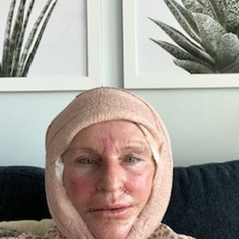 Clevens Face and Body Specialists - Third surgery for my neck Still showing - Medical Spas Near Me - Melbourne, Florida Clevens Face and Body Specialists - Third surgery for my neck Still showing - Medical Spas Near Me - Melbourne, Florida
