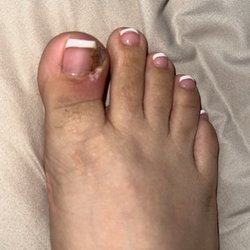 LA Nails - Infection from pedicure