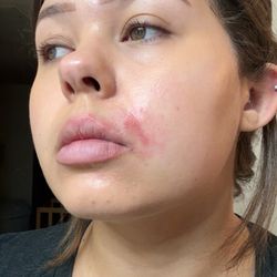 Conejo Dermatology - My face the day I went into dermatology