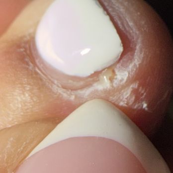 Athena Nails & Head Spa - Pus coming from the cuticle area - Nail Salons Near Me - Sacramento, California