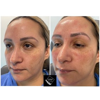 Inspired Med Spa - Under eye Filler - Medical Spas Near Me - Rancho Cucamonga, California Inspired Med Spa - Under eye Filler - Medical Spas Near Me - Rancho Cucamonga, California