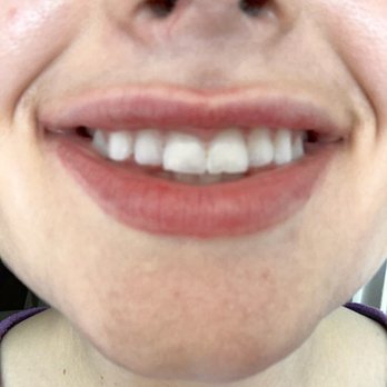 LaserAway - After lip fillers - Laser Hair Removal Near Me - Huntington Beach, California
