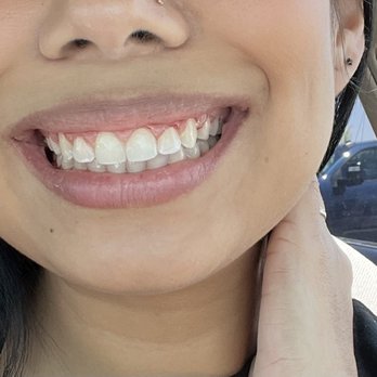 Cardall Orthodontics - After - Orthodontists Near Me - Bakersfield, California Cardall Orthodontics - After - Orthodontists Near Me - Bakersfield, California