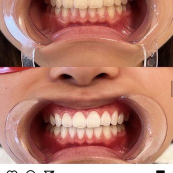 Beauty House - This is the before/ after pic of my teeth Wendy is using on her IG page without my permission - Permanent Makeup Near Me - Urban Honolulu, Hawaii Beauty House - This is the before/ after pic of my teeth Wendy is using on her IG page without my permission - Permanent Makeup Near Me - Urban Honolulu, Hawaii
