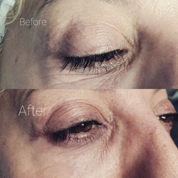 Lanadel Spa - Plasma pen treatment