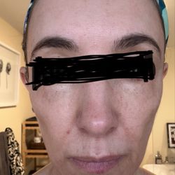 River Medical Cosmetic Surgery - Less than a week after CO2 laser