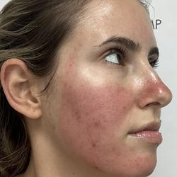 OC Esthetique and Spa - RIGHT AFTER a SkinPen Microneedling session. This picture was taken 5 minutes after the session.