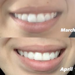 Lip flip-$150 Lip flip-$150