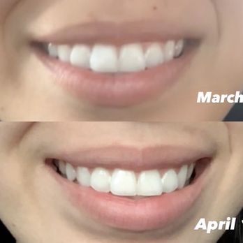 OVME - Lip flip-$150 - Skin Care Near Me - Houston, Texas OVME - Lip flip-$150 - Skin Care Near Me - Houston, Texas