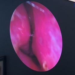 Capitol Breathe Free Sinus & Allergy Centers - Camera looking inside the nose... you can watch on the big screen to understand and see better. The tech here is crazy!