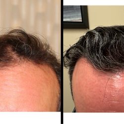 Modena Hair Transplant Institute - 28 year old male with FUE hair transplant to the frontal zone. Note how natural the patients results look