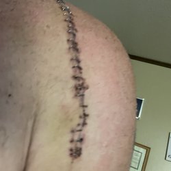 Jones & Cowen Physical Therapy - Complete shoulder replacement