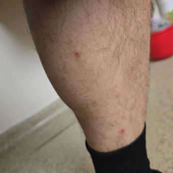 Flamingo Las Vegas - Bites on his leg from bed bugs - Hotels Near Me - Las Vegas, Nevada Flamingo Las Vegas - Bites on his leg from bed bugs - Hotels Near Me - Las Vegas, Nevada
