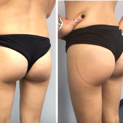 Fusion - Non Surgical Brazilian Butt Lift