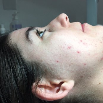 Acne Specialist Marlene Wolfberg - Before - Acne Treatment Near Me - Glendale, California