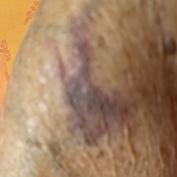 Quest Diagnostics - Bruised area upper right arm. - Laboratory Testing Near Me - Oxnard, California Quest Diagnostics - Bruised area upper right arm. - Laboratory Testing Near Me - Oxnard, California