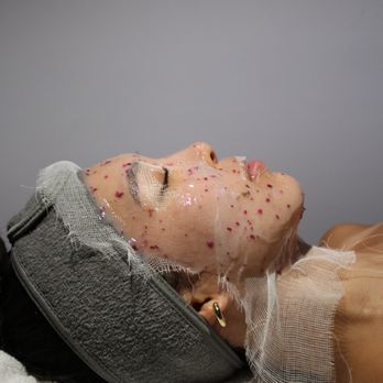 Nios Skin Lab - Hydrojelly mask facial - Laser Hair Removal Near Me - Brooklyn, New York Nios Skin Lab - Hydrojelly mask facial - Laser Hair Removal Near Me - Brooklyn, New York